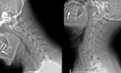 頸椎の屈曲、伸展の画像
